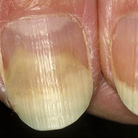 fungal infections of the nails