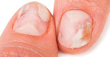 fingernail fungus treatment