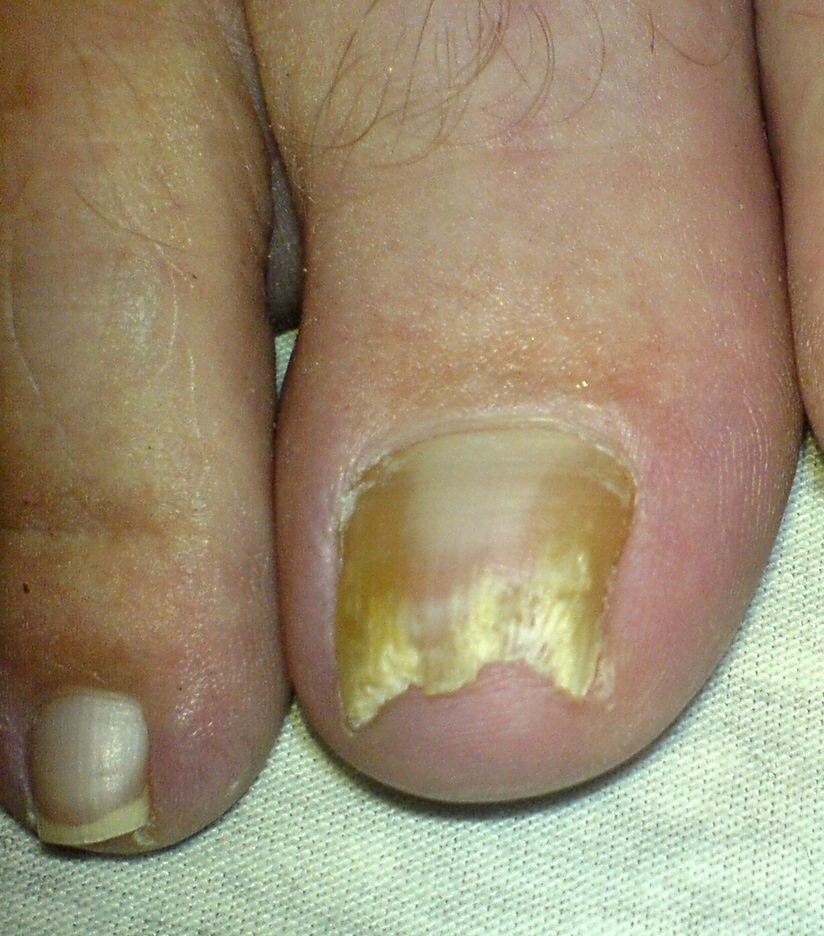 nail treatment before