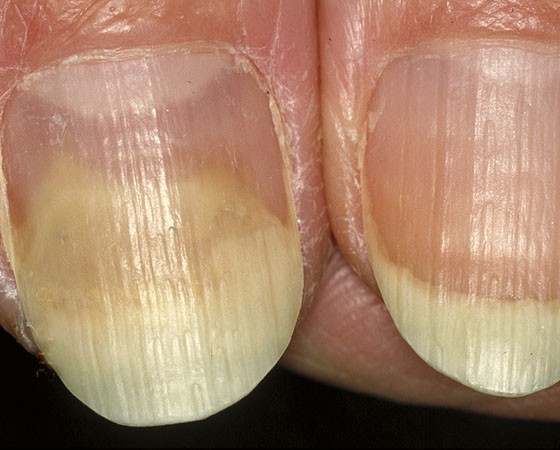 What are loose nails and how to treat them | Fix-4-Nails