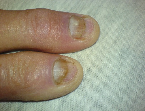 nail fungus infection