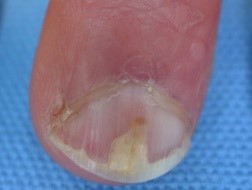 Diabetes Nails - Loose Nails