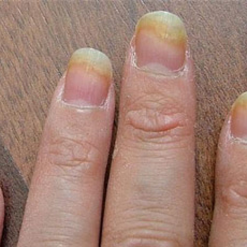 Nail fungus in loose nails
