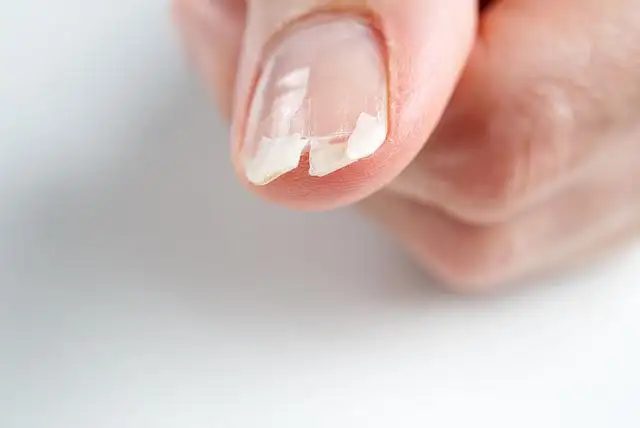 Brittle Nails