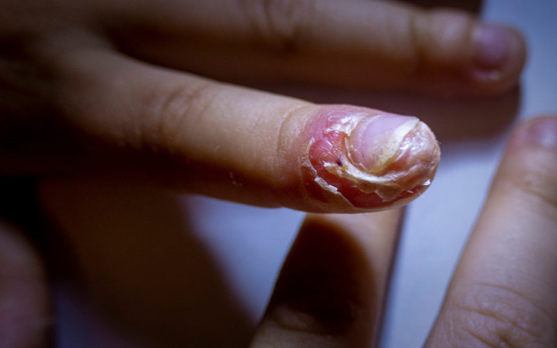 Nail Infections | Nail Hygiene